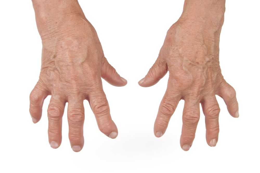 Ревматоидный артрит: причины, механизмы развития, симптомы
