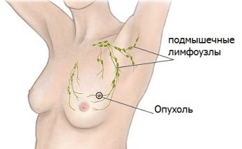первые признаки рака молочной железы
