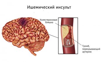 Транзиторная ишемическая атака: причины, лечение и профилактика