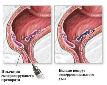 Хирургическое лечение геморроя