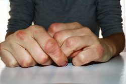 6 продуктов, о которых лучше забыть при псориазе
