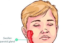 Болезнь свинка – симптомы, лечение и профилактика