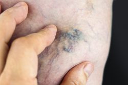 Профилактика венозных заболеваний при сидячей работе: простые правила