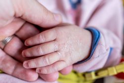 Шершавая кожа у ребенка: причины и рекомендации
