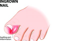 Вросший ноготь: лечение в домашних условиях