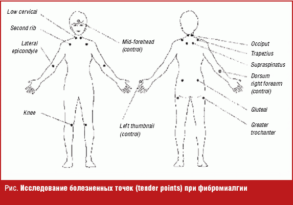 Фибромиалгия диагностика и лечение