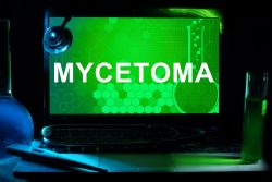 Мицетома гайморовой пазухи